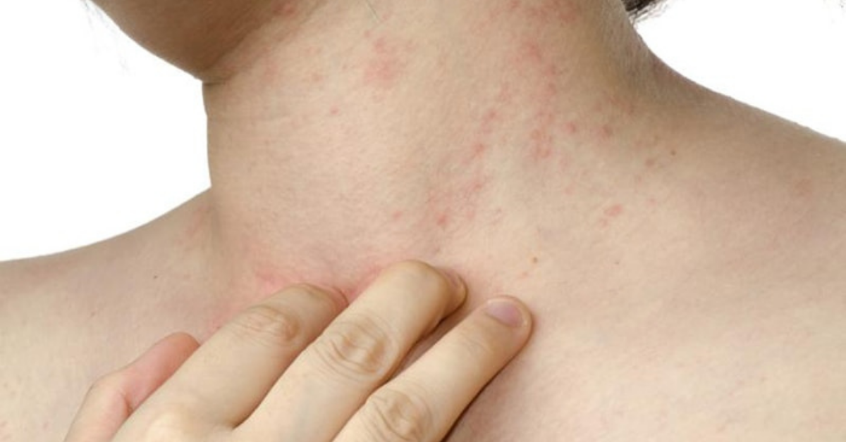 Những điều cần biết về bệnh sẩn ngứa