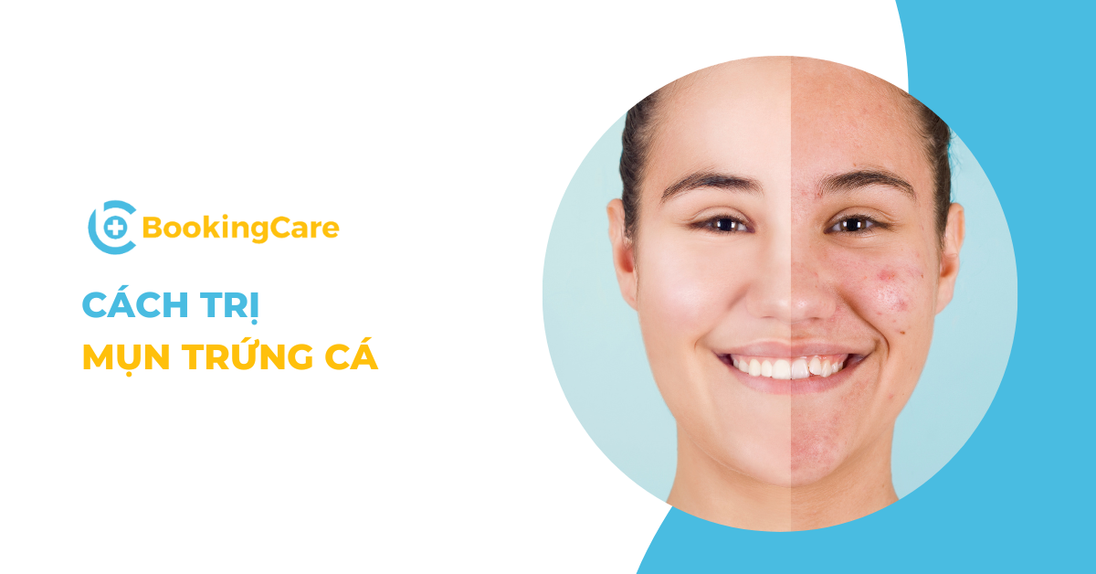 Cách trị mụn trứng cá