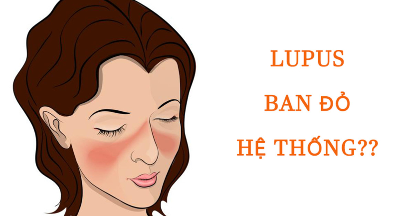 bệnh lupus ban đỏ hệ thống