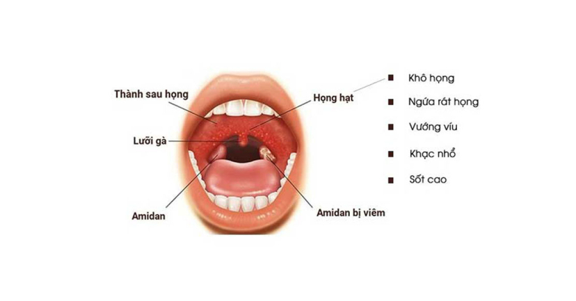 Cách chữa viêm họng hạt