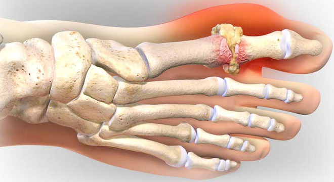 bệnh gout là bệnh cơ xương khớp thường gặp 