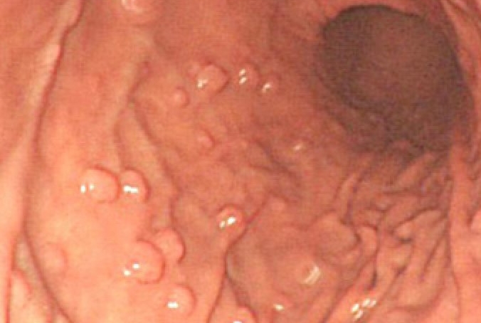 Các khối polyp nhìn thấy trong nội soi dạ dày