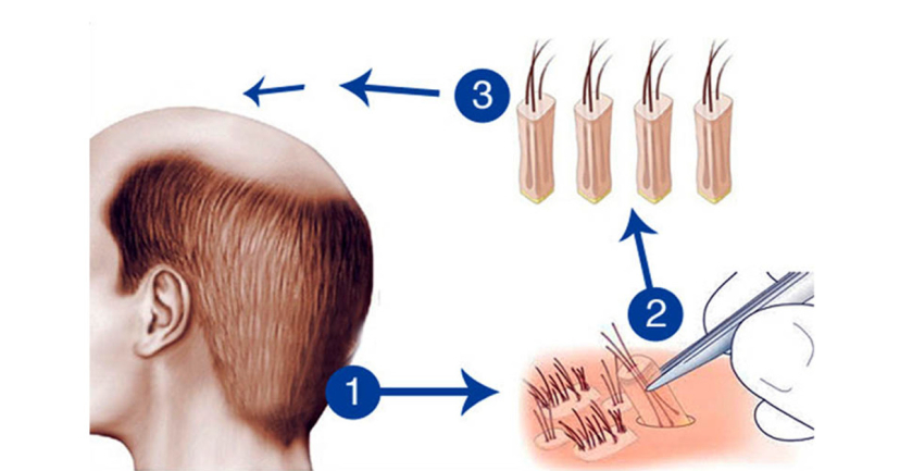 Thận yếu gây rụng tóc Nguyên nhân và cách khắc phục