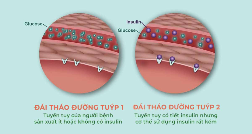 Nguyên nhân bệnh tiểu đường tuýp 1 và tuýp 2