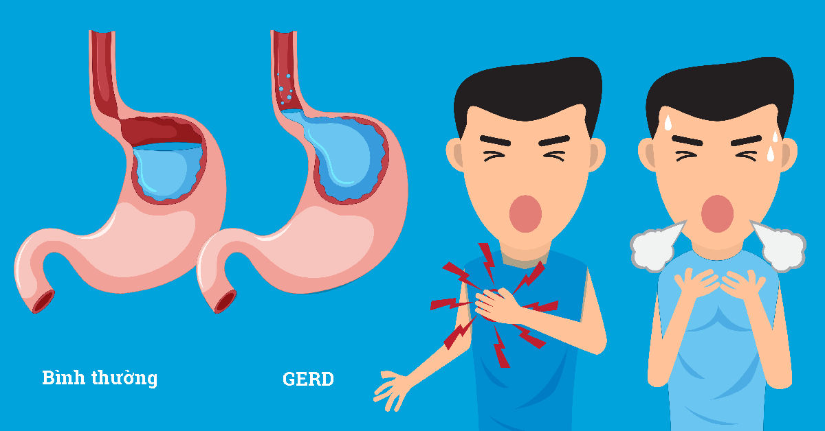 Ợ nóng là một triệu chứng điển hình của trào ngược dạ dày thực quản (GERD) 