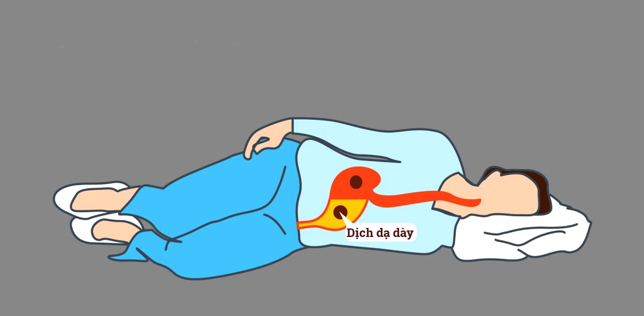 Kê cao đầu giường và nằm nghiêng trái tốt cho người bệnh trào ngược dạ dày 